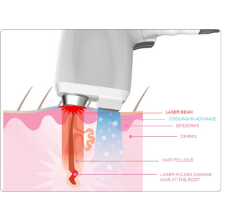 Fast Permanent Laser Hair Removal